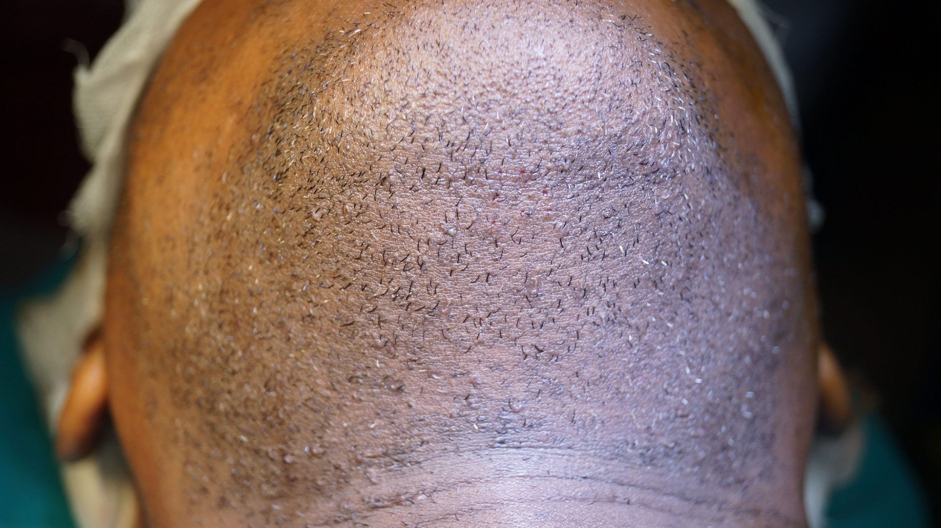 Extraction from Beard