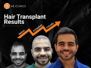 hair transplant result at AK Clinics